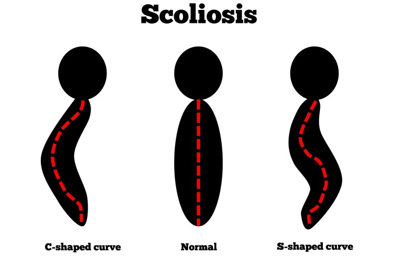 Charleston, WV scoliosis treatment